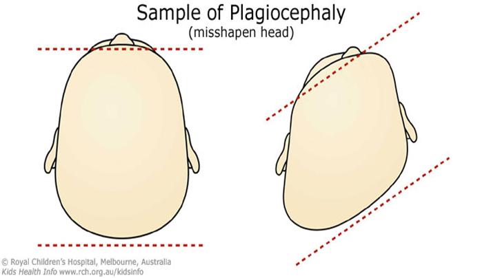 Sample of Plagiocephaly